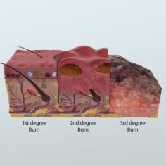 3D model Realistic 3D Skin Burrn Anatomy 3D Model