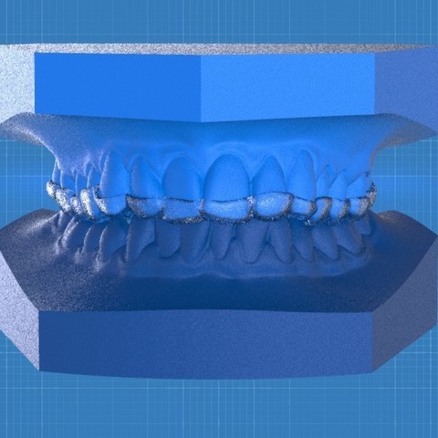 Digital Ortho Anterior Repositioner Splint 3D Print Model