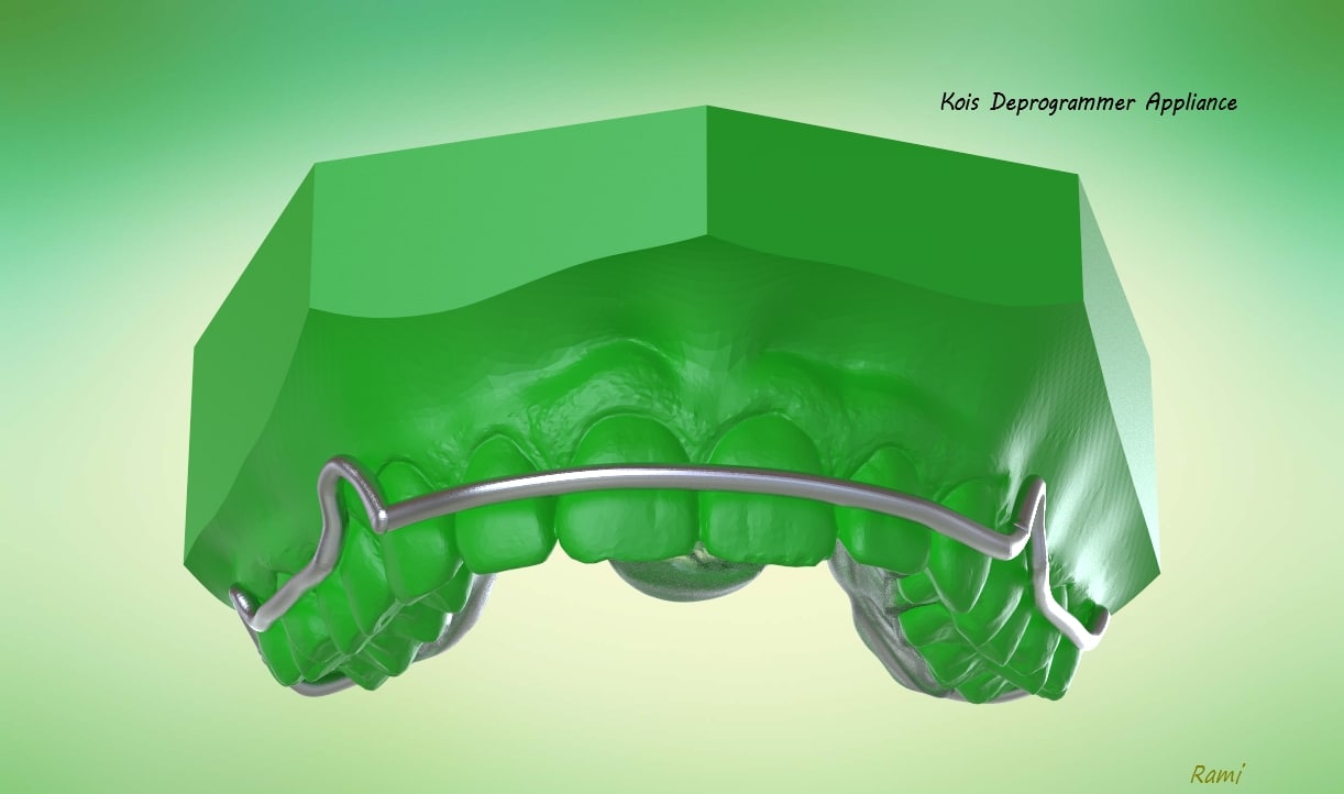 Digital Ortho Kois Deprogrammer Appliance 3D Model
