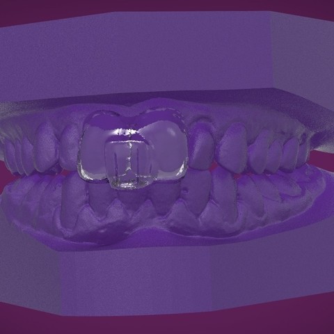 Digital Sleep Clench Inhibitor 3D Print Model