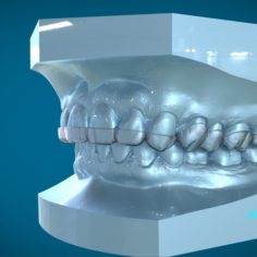 Digital Dental Dayguard Splint 3D Print Model