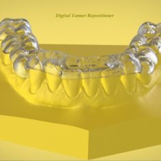 Digital Ortho Tanner Repositioner Splint 3D Print Model