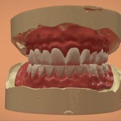 Digital Complete Dentures 3D Print Model