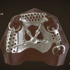 Digital Removable Partial Denture Framework 3D Print Model