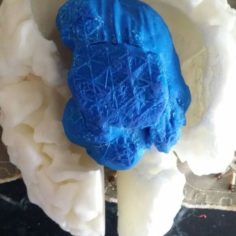 mri brain tumor 3D Print Model