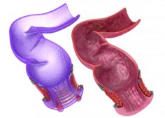 Human anatomy rectum and hemorrhoids 3D Model