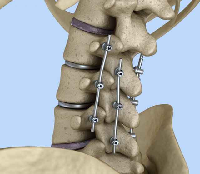 Spinal fixation system – titanium bracket 3D Model